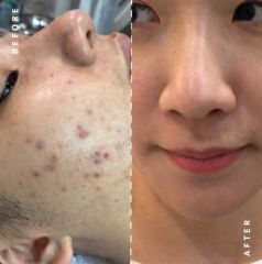 Acne Treatment Before After