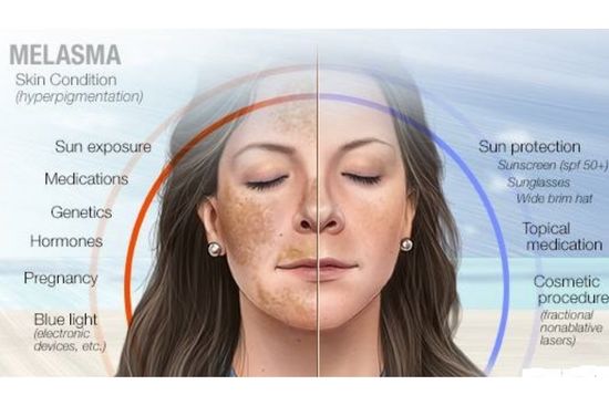 Pigmentation Reasons