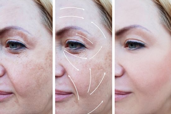 Pigmentation Treatment Result