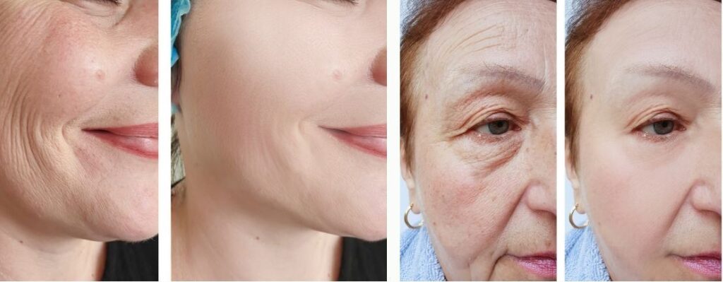 Skin Tightening Results