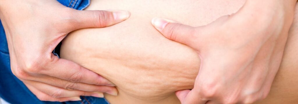 cellulite